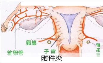 引起附件炎的因素