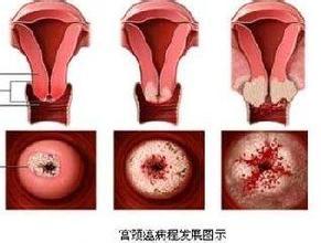 宫颈息肉不及时治疗会出现什么危害