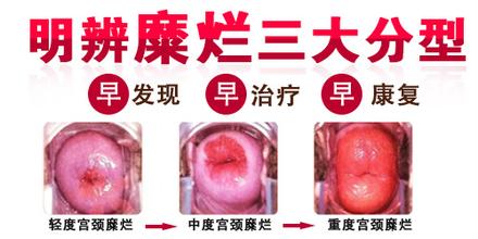 宫颈糜烂会有哪些危害呢