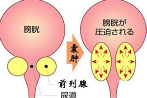 如何预防前列腺囊肿