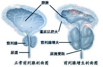 诱发前列腺增生的因素有哪些