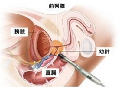 如何预防前列腺增生