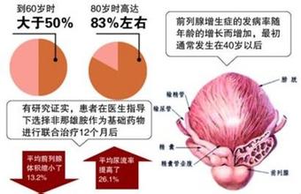 治疗前列腺增生好的方法