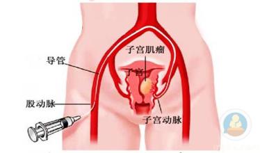 子宫肌瘤有哪些症状
