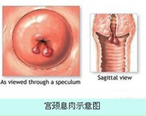 宫颈息肉会产生哪些危害