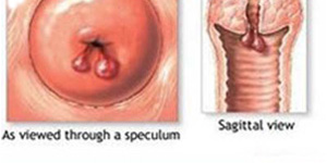 宫颈息肉的早期症状有哪些