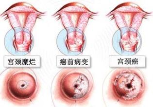 昌吉治疗宫颈炎需要多少钱