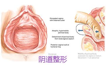 昌吉女性缩阴方法有哪些