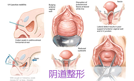 阴道紧缩术后有哪些护理