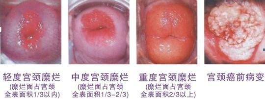 治疗宫颈糜烂需要多少钱